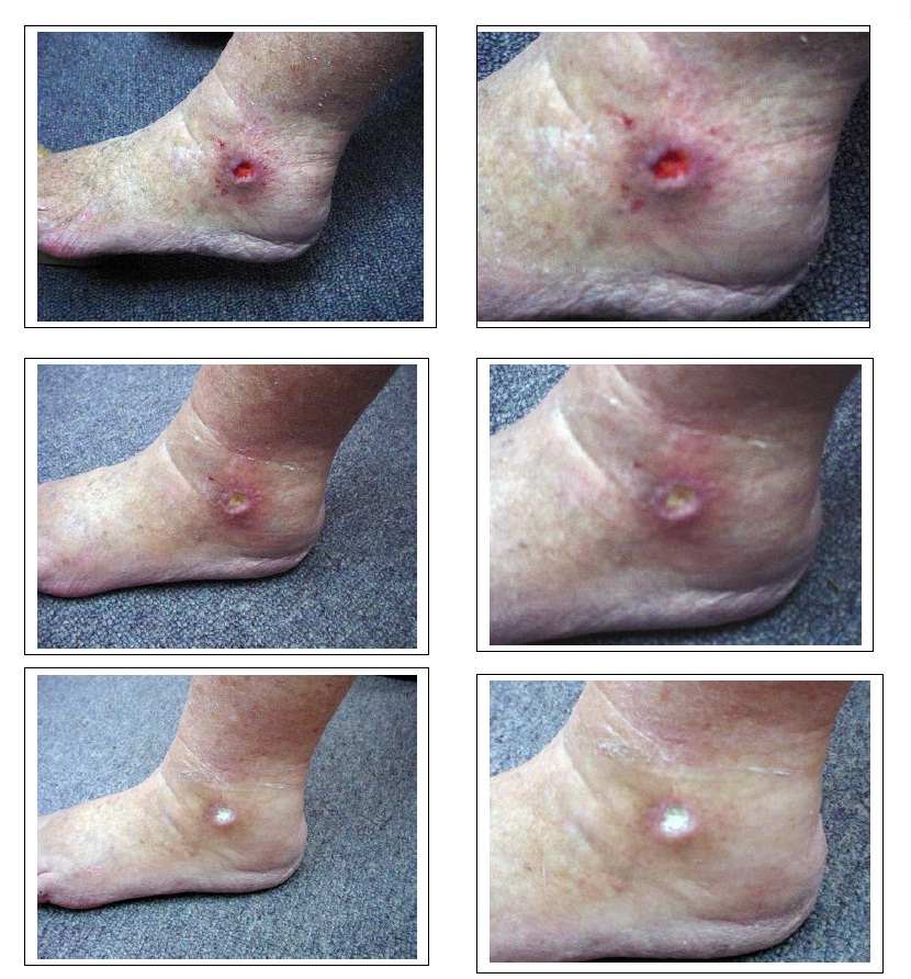 Chronic Venous Insufficiency and Postphlebitic Syndrome ...