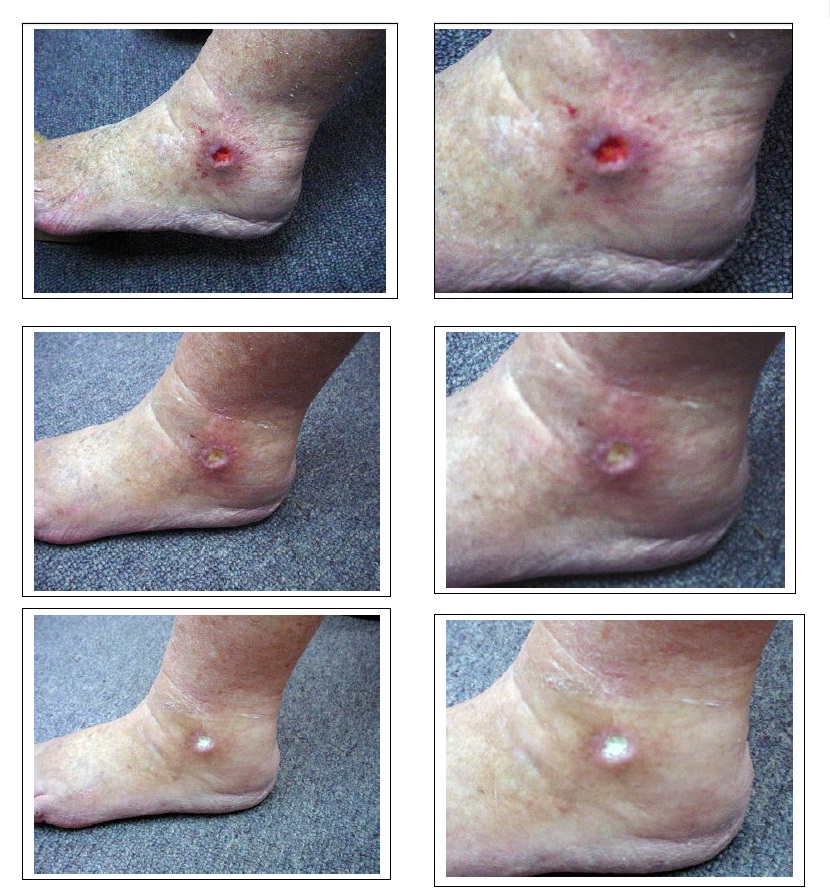 venous insufficiency ulcer - pictures, photos